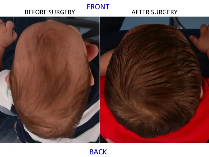 drderderian.com Minimally Invasive Sagittal Strip Craniectomy Case 1 Top Down View