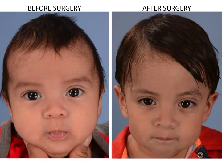 drderderian.com Minimally Invasive Sagittal Strip Craniectomy Case 16 AP