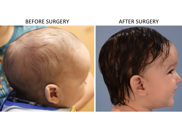 drderderian.com Minimally Invasive Sagittal Strip Craniectomy Case 18 Lateral View