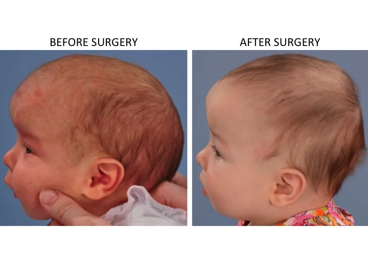 drderderian.com Minimally Invasive Sagittal Strip Craniectomy Case 15 Lateral View