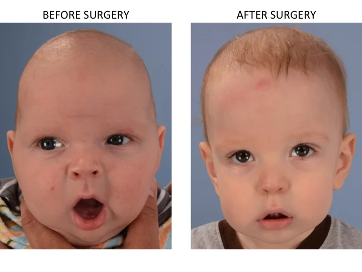 drderderian.com Minimally Invasive Sagittal Strip Craniectomy Case 17 AP