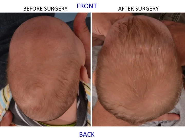 drderderian.com Minimally Invasive Sagittal Strip Craniectomy Case 17 Top Down View