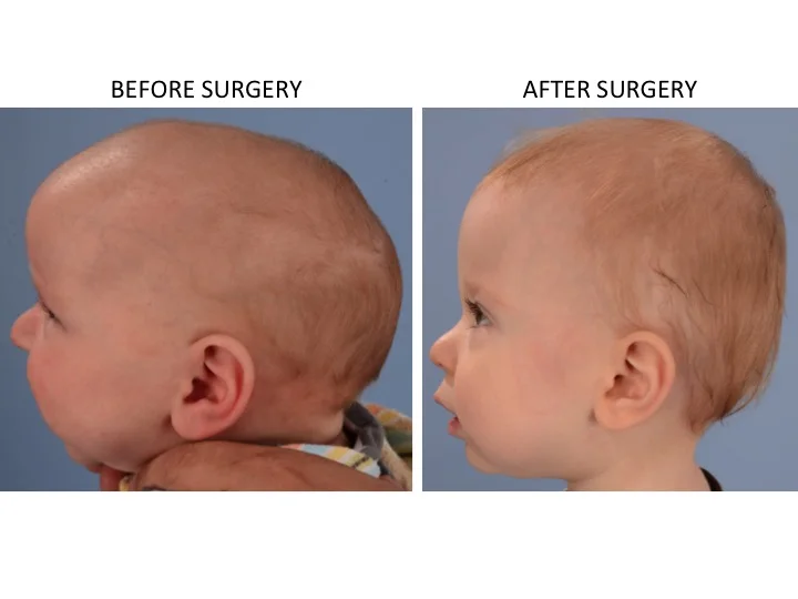 drderderian.com Minimally Invasive Sagittal Strip Craniectomy Case 17 Lateral View