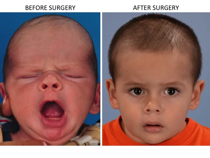 drderderian.com Minimally Invasive Sagittal Strip Craniectomy Case 12 AP