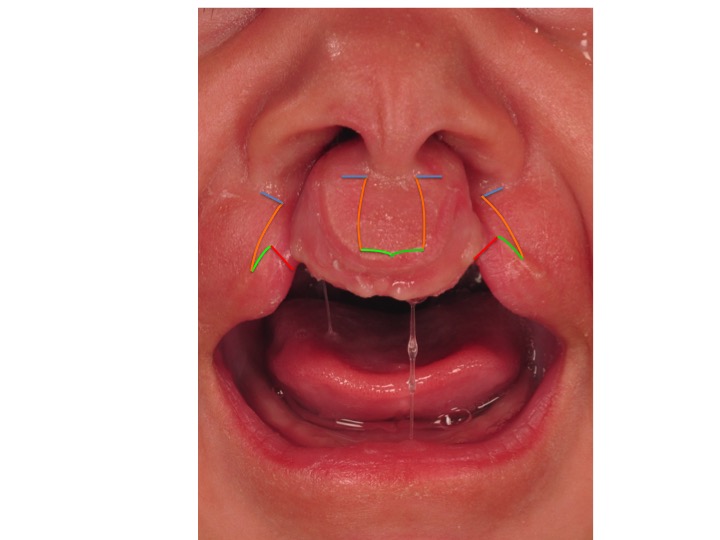 This figure shows where the incisions are placed for the most commonly performed bilateral cleft lip repairs. The incisions are designed to allow the lip to have a balanced appearance, while hiding the scars in the line created by the philtral columns. The incisions are color-coded to show where the central and lateral lip elements will fit together on each side (red-to-red, green-to-green, orange-to-orange, etc).