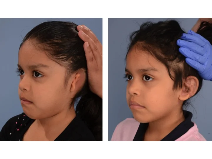 drderderian.com ear reconstruction Case 1 Left 3/4 View