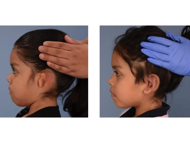 drderderian.com ear reconstruction Case 1 Left View