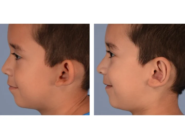 Derderian Otoplasty Case 2 Left Lateral