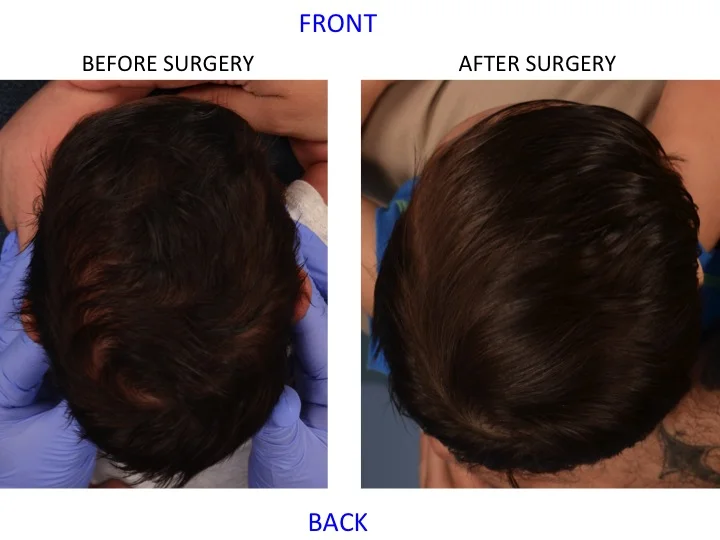 drderderian.com Minimally Invasive Sagittal Strip Craniectomy Case 9 Top Down View