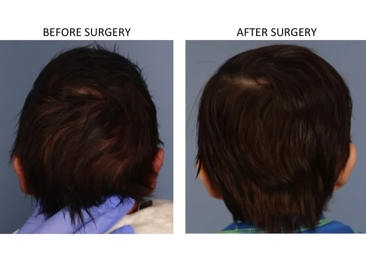 drderderian.com Minimally Invasive Sagittal Strip Craniectomy Case 9 Posterior View
