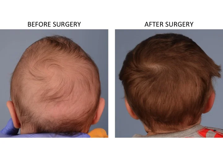 drderderian.com Minimally Invasive Sagittal Strip Craniectomy Case 6 Posterior View