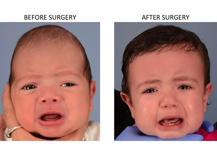 drderderian.com Minimally Invasive Sagittal Strip Craniectomy Case 8 AP