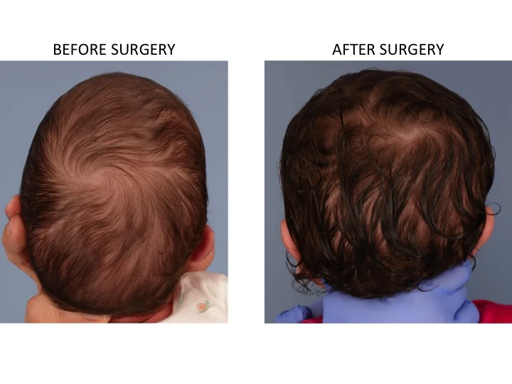 drderderian.com Minimally Invasive Sagittal Strip Craniectomy Case 8 Posterior View