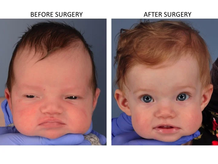 drderderian.com Minimally Invasive Sagittal Strip Craniectomy Case 2 AP