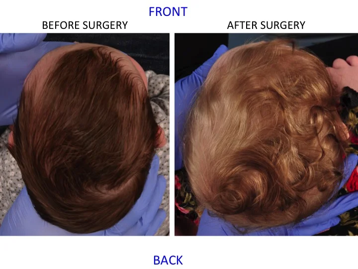 drderderian.com Minimally Invasive Sagittal Strip Craniectomy Case 2 Top Down View