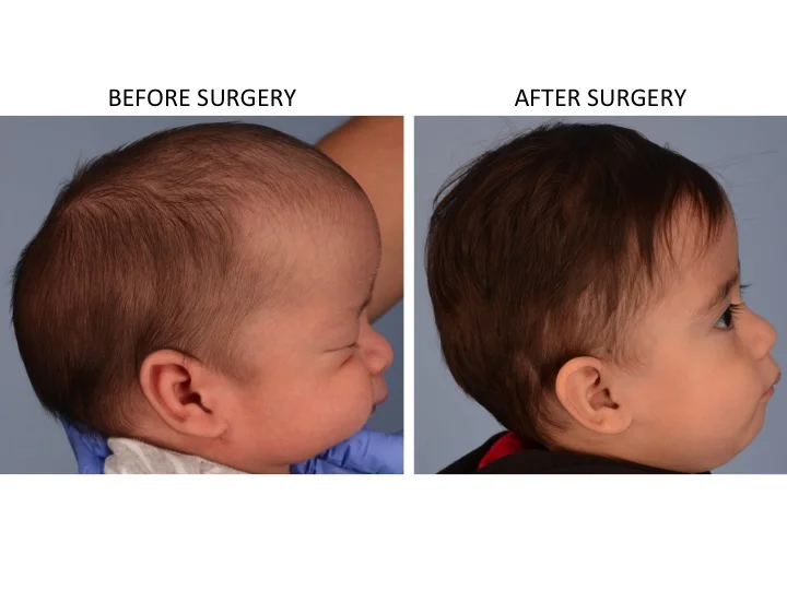 drderderian.com Minimally Invasive Sagittal Strip Craniectomy Case 4 Lateral View