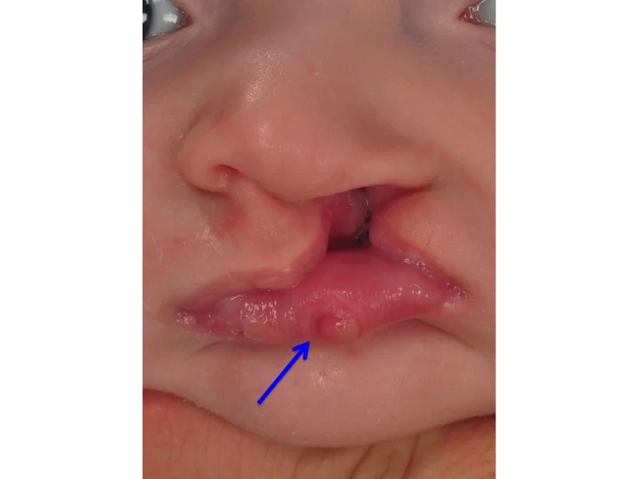 The characteristic feature of Van der Woude syndrome are lower lip pits as shown by the blue arrow.