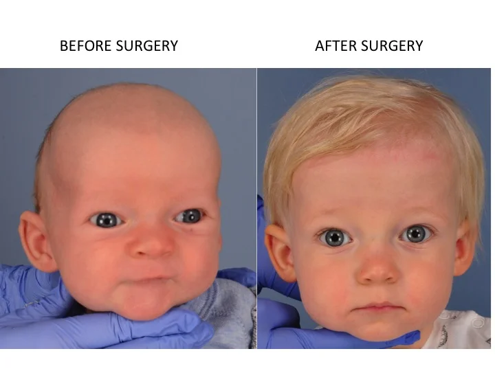 drderderian.com Minimally Invasive Sagittal Strip Craniectomy Case 3 AP