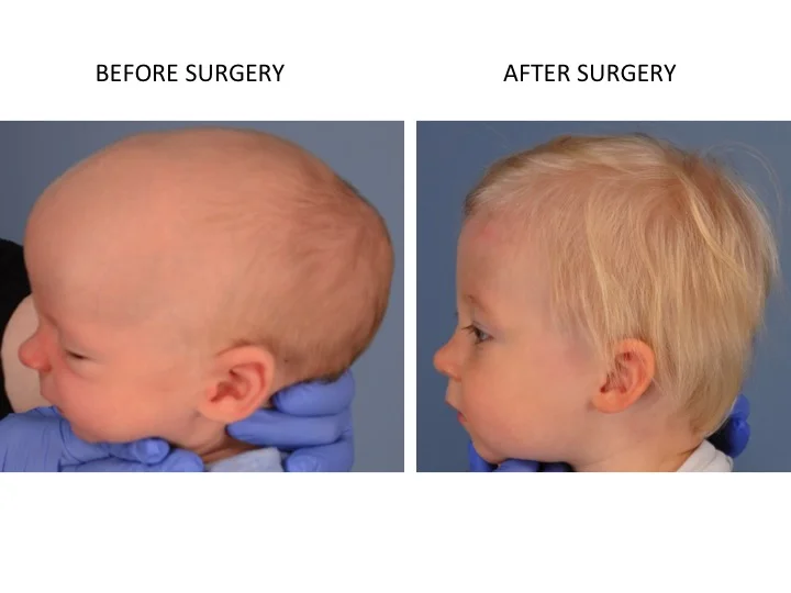 drderderian.com Minimally Invasive Sagittal Strip Craniectomy Case 3 Lateral View