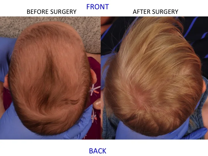 drderderian.com Minimally Invasive Sagittal Strip Craniectomy Case 7 Top Down View