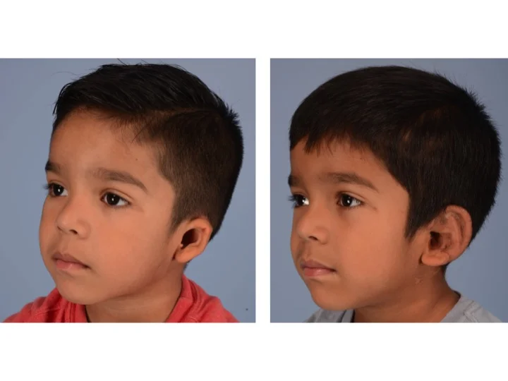 drderderian.com Ear Reconstruction Case 2 Left 3/4 View