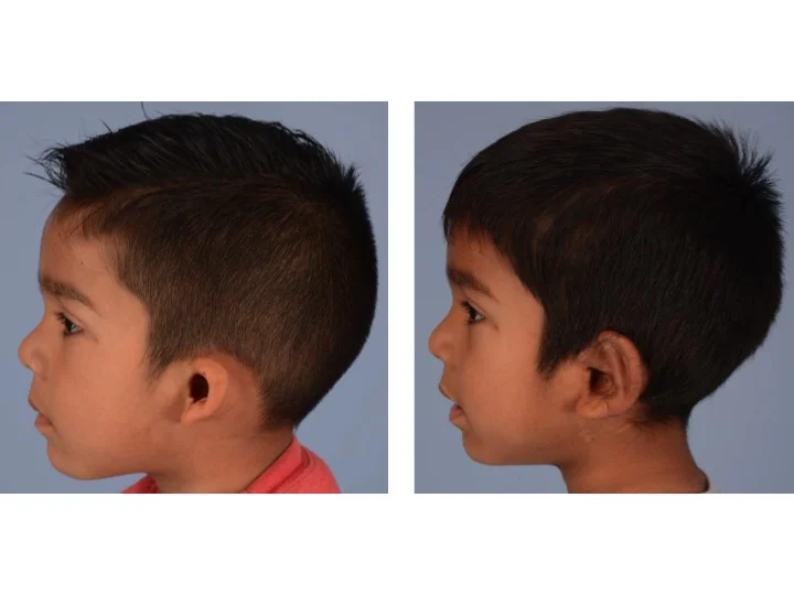 drderderian.com Ear Reconstruction Case 2 Left Lateral View