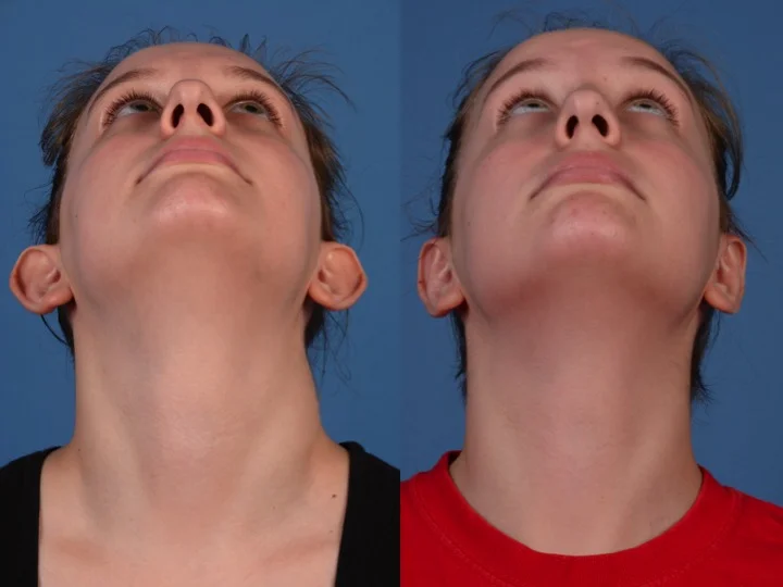 drderderian.com Otoplasty Case 3 Below View