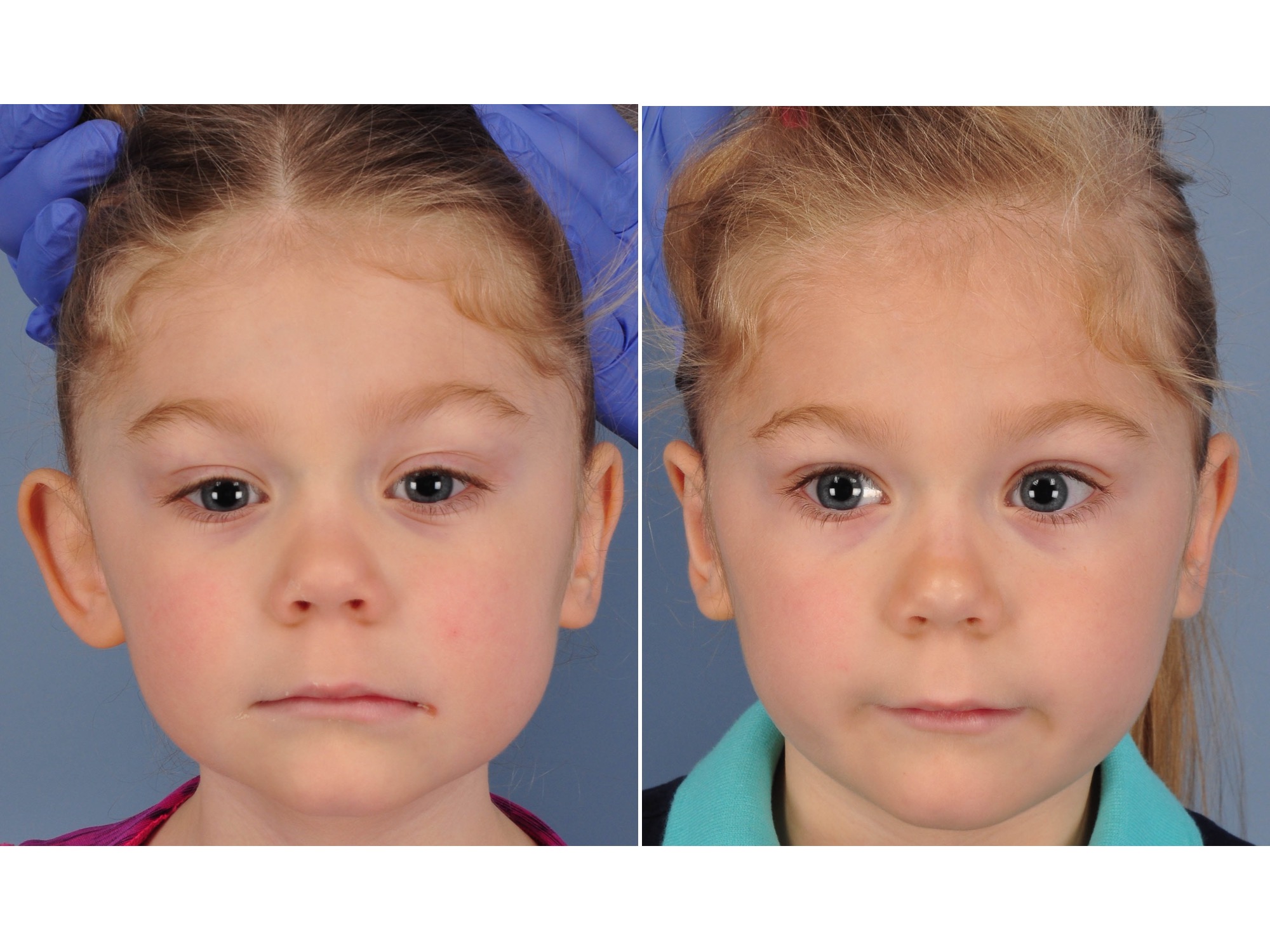 drderderian.com Otoplasty Case 4 AP