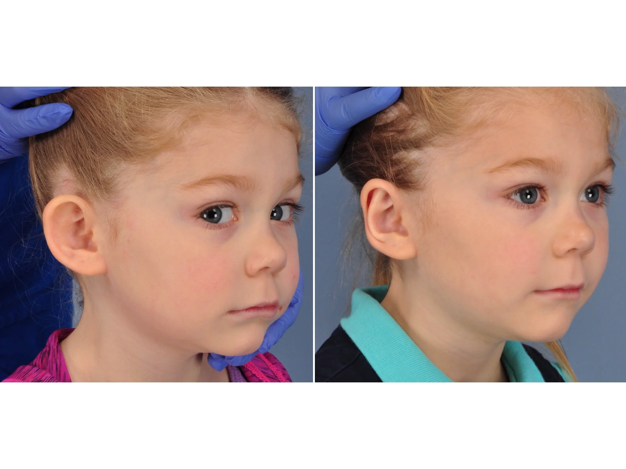 drderderian.com Otoplasty Case 4 Right 3/4 View