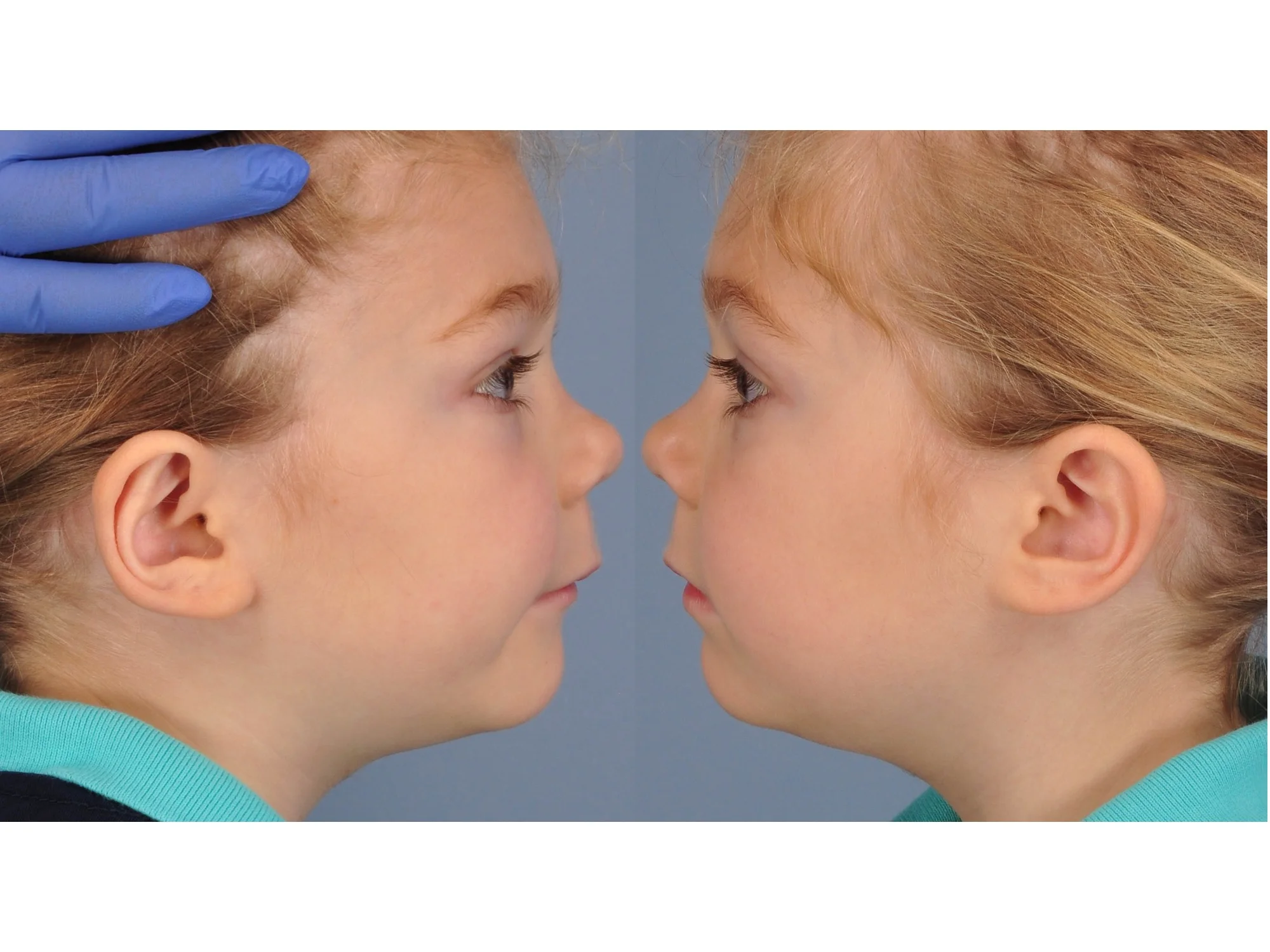 drderderian.com Otoplasty Case 4 Mirror Image View
