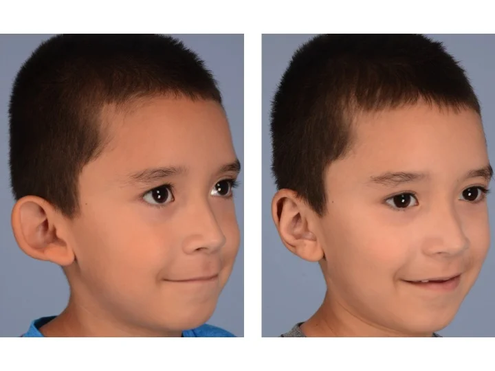 This figure shows the same boy before and after otoplasty in which suture techniques are used to create normal contours and projection in the ear. These techniques are possible because a normal amount of skin and cartilage are present in the ear.