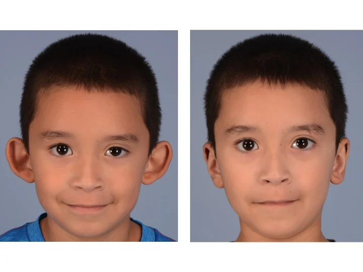 This 6 year old boy had prominent ears that “stuck out too far” from the head and lacked the normal contours and features of an ear. However he had a normal amount of skin and cartilage.