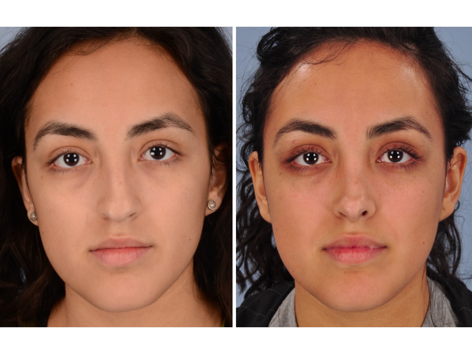 Rhinoplasty Surgery Austin