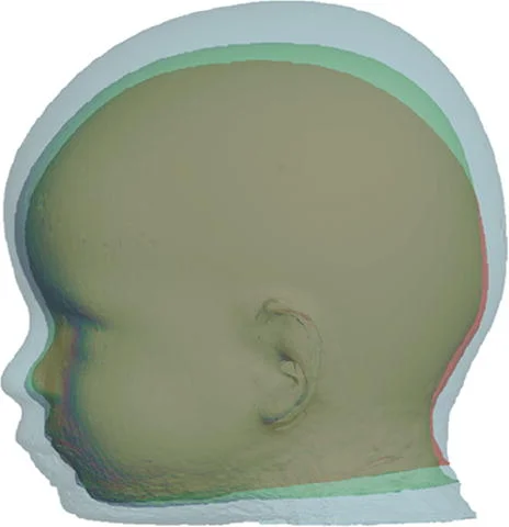 3D Changes after sagittal strip drderderian.com.jpg