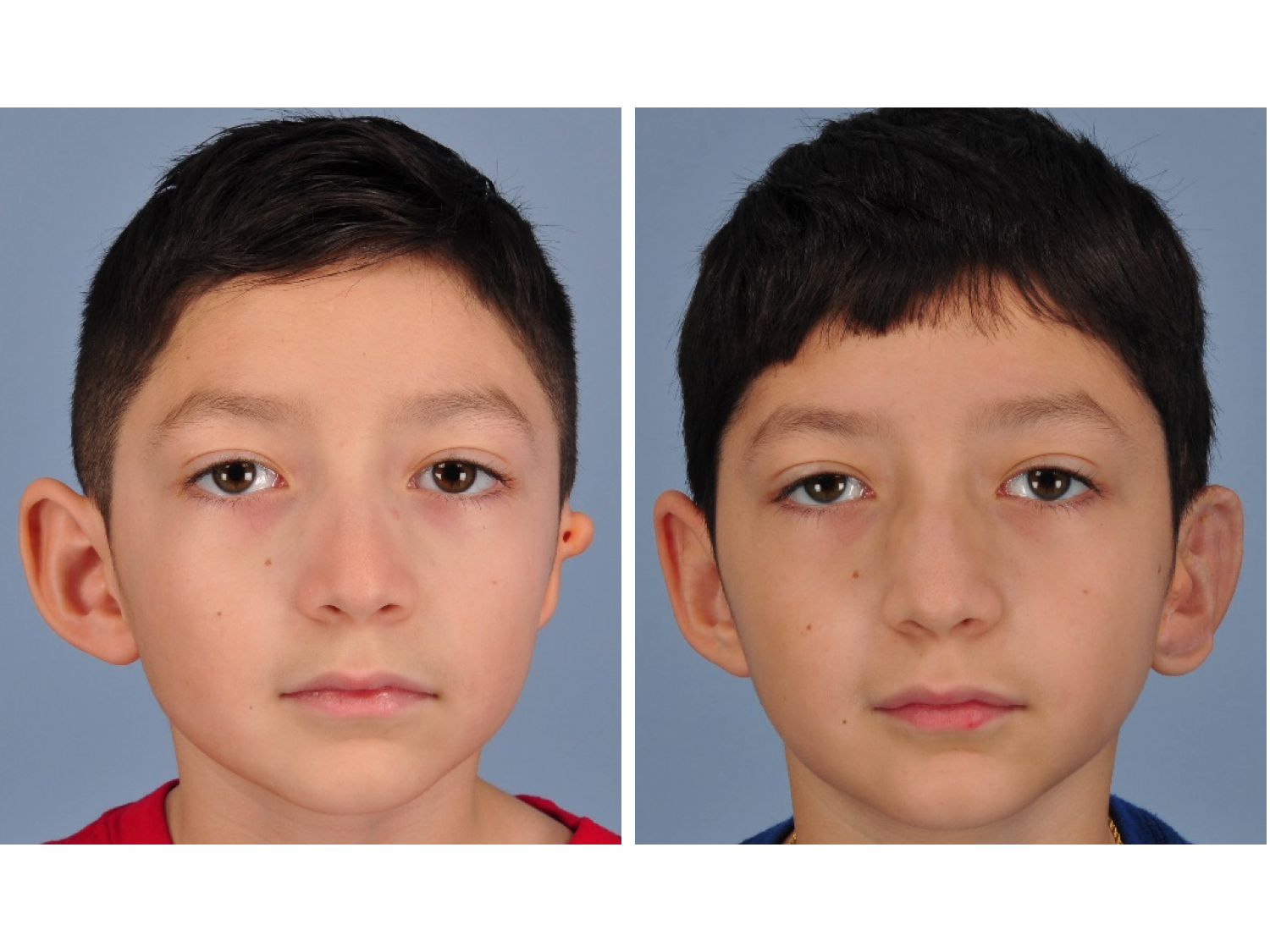 drderderian.com medpor ear reconstruction before and after AP
