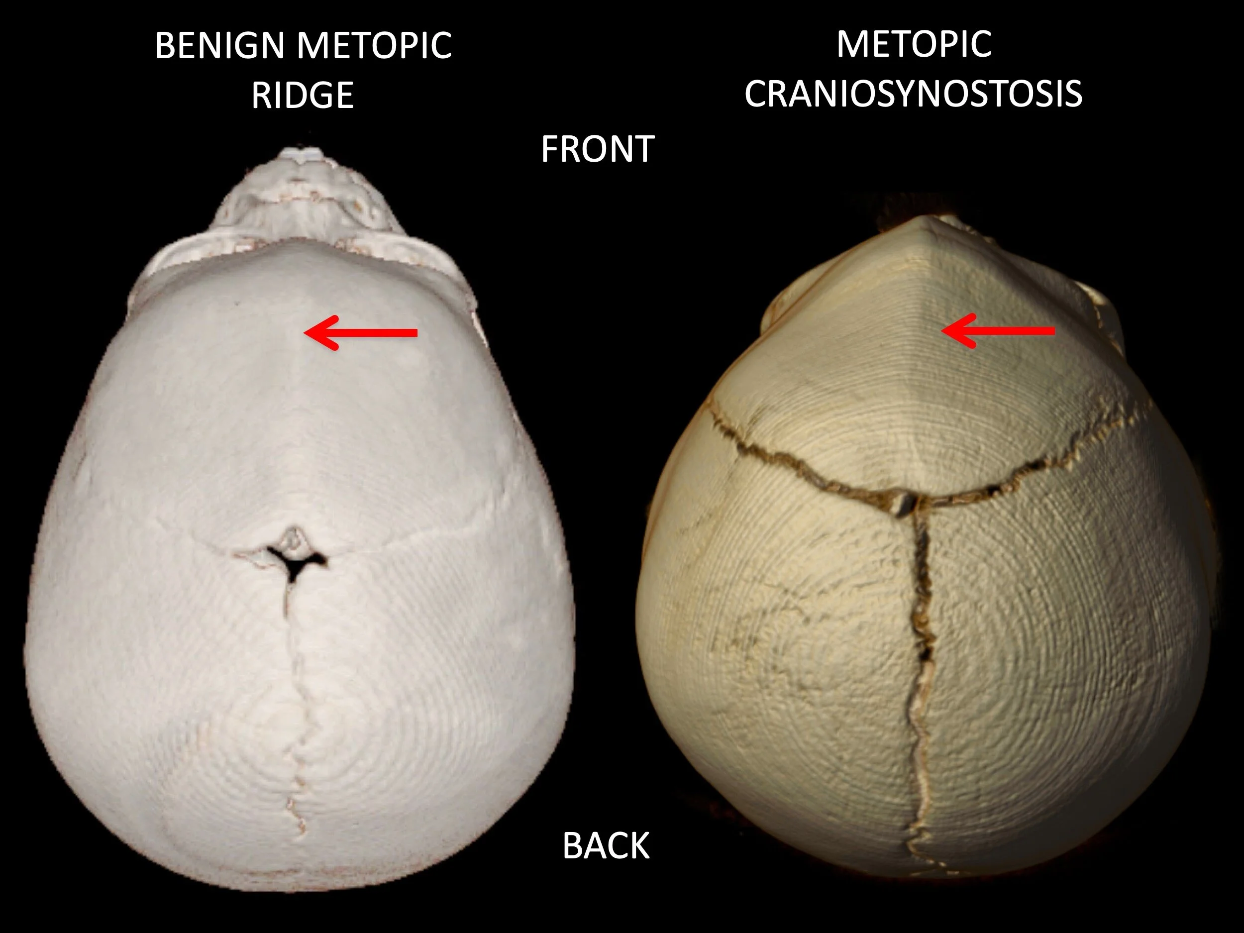 Metopic Synostosis (Trigonocephaly) — Dallas Plastic Surgeon
