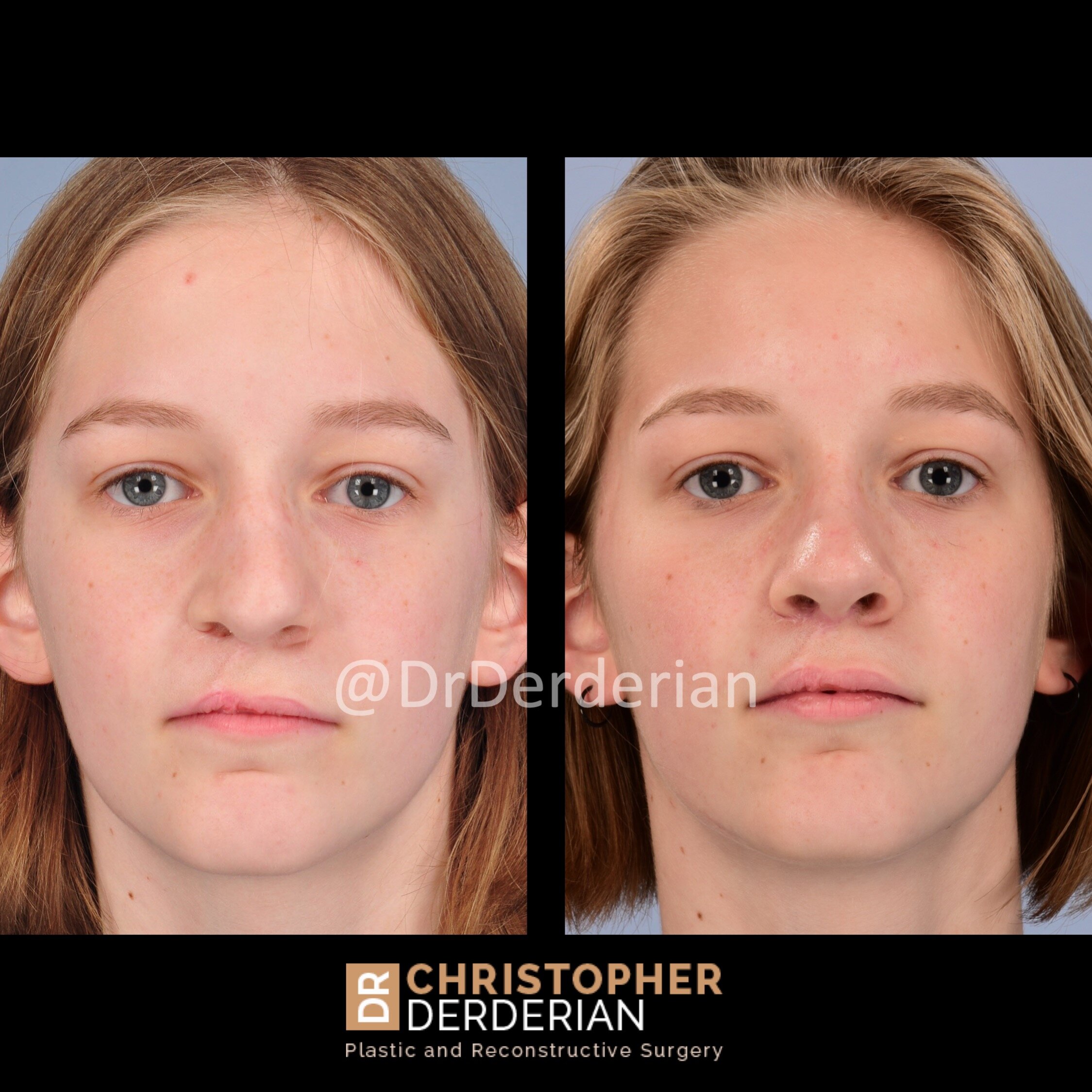See This Report about Cosmetic Nose Surgery Austin