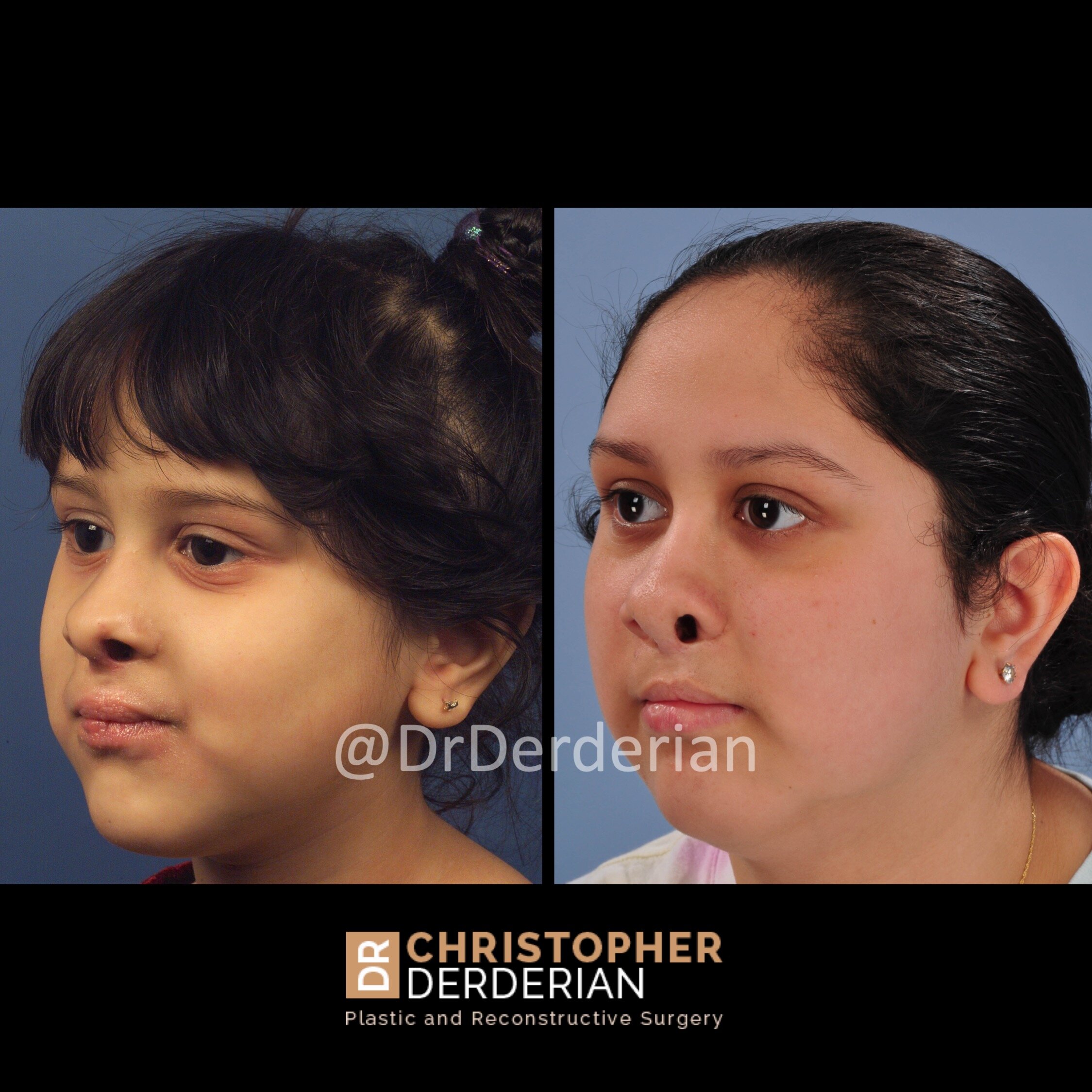 Cleft+Nasal+Deformity+With+Growth
