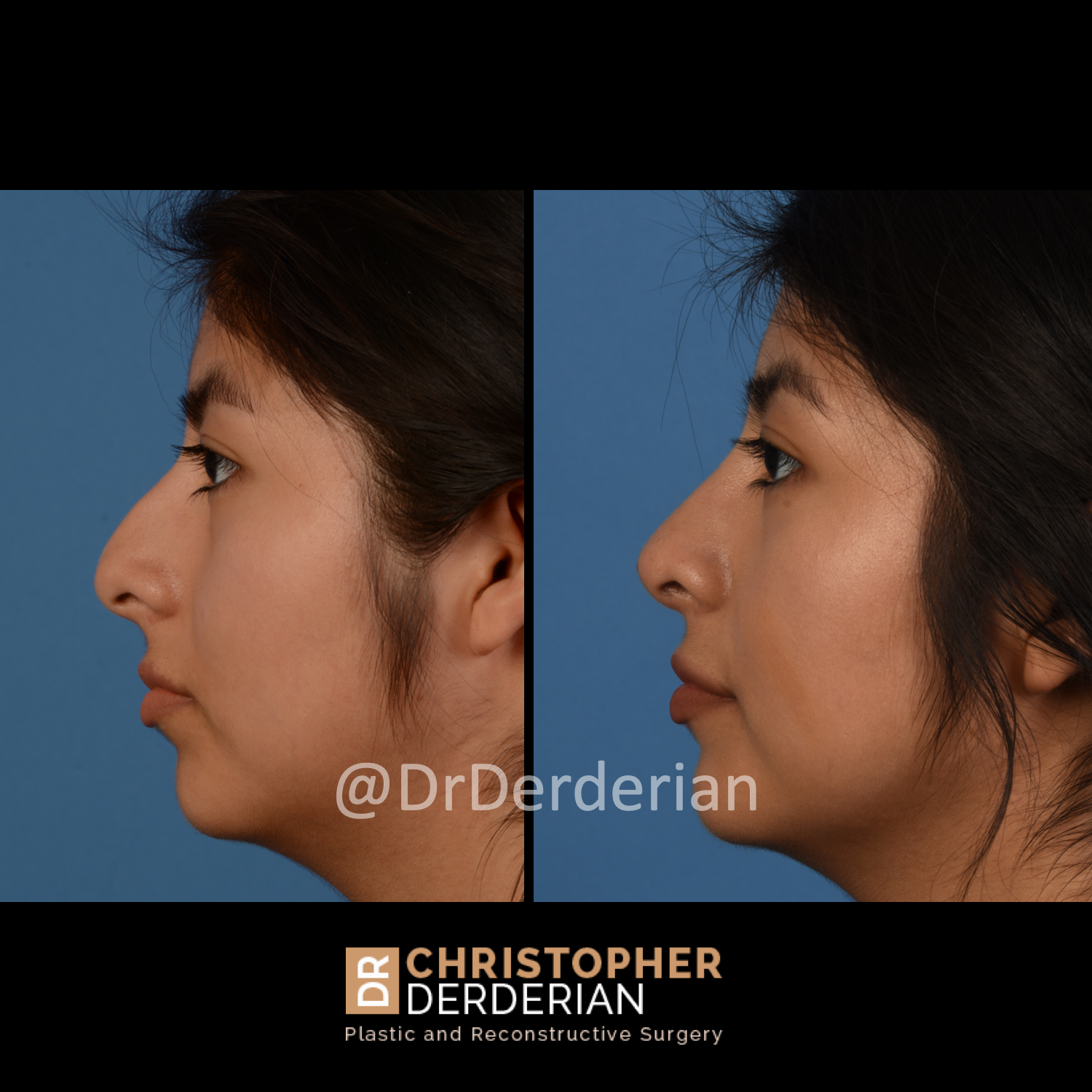 Rhinoplasty (Nose Job) — Dallas Plastic Surgeon specializing in