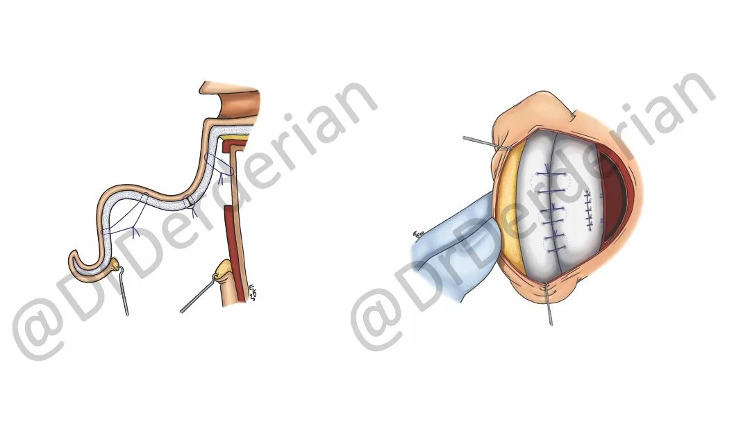 Otoplasty (Ear Surgery) — Dallas Plastic Surgeon specializing in
