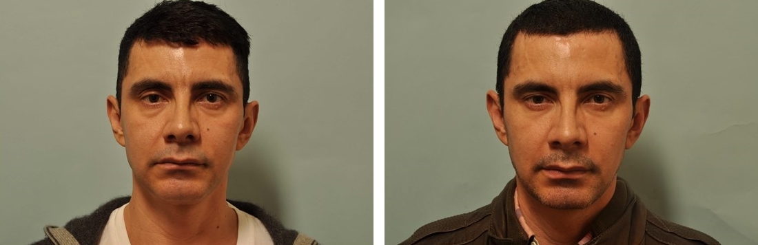 Restylane and Dysport