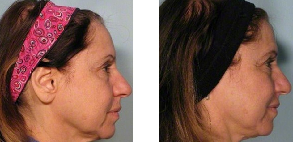 64 year old patient had one treatment of Ultherapy to her lower face and neck.
