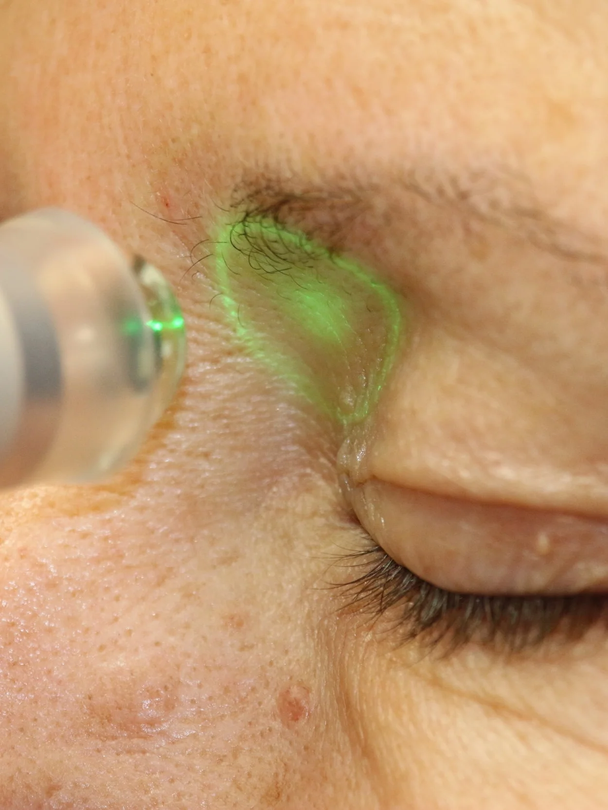 The SYntonac Local-Focal line is