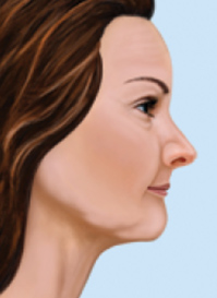  after tooth loss