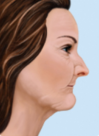  after bone loss
