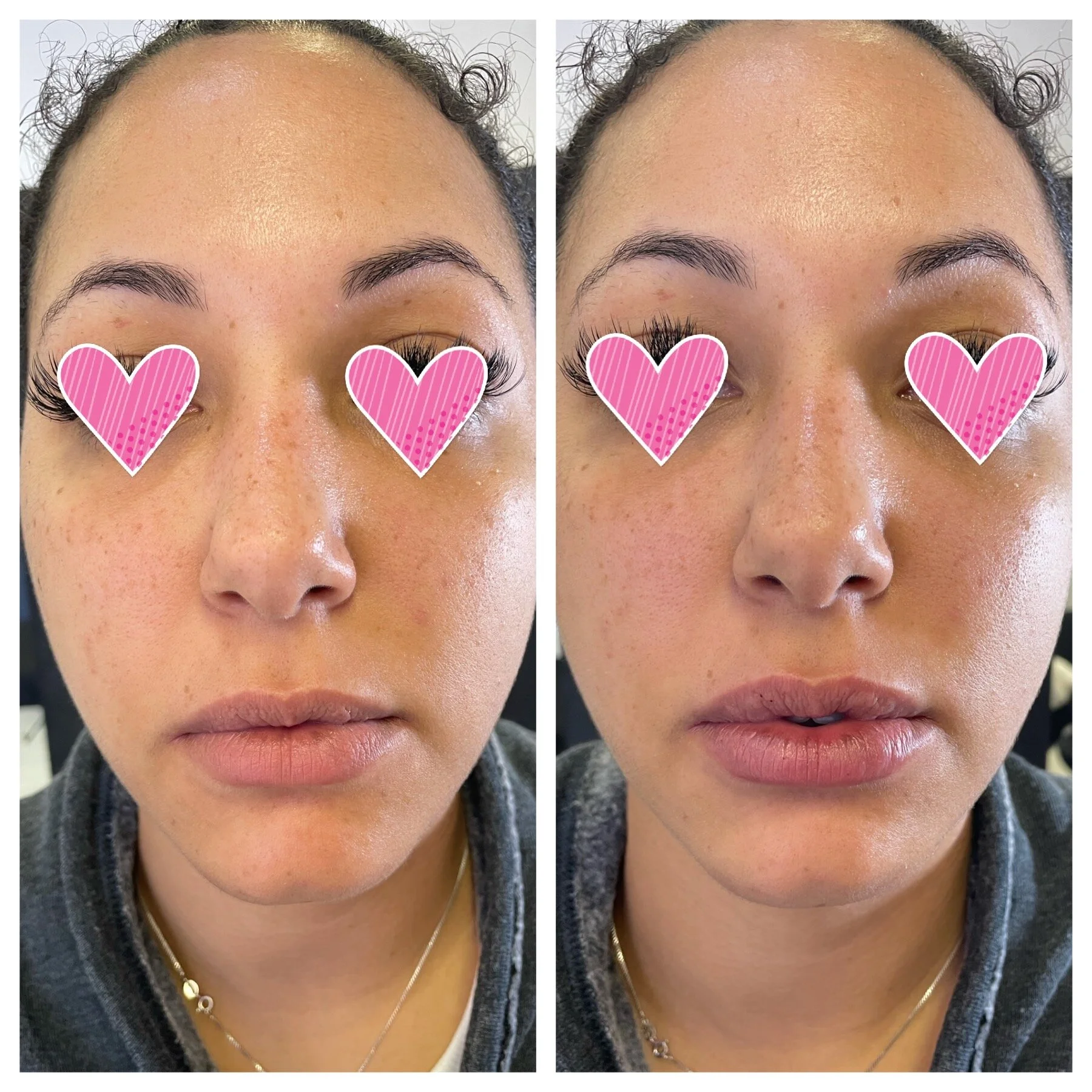 NeedleLess Lip Fillers,Microcurrent, Botox Facial, Eyelash Extensions