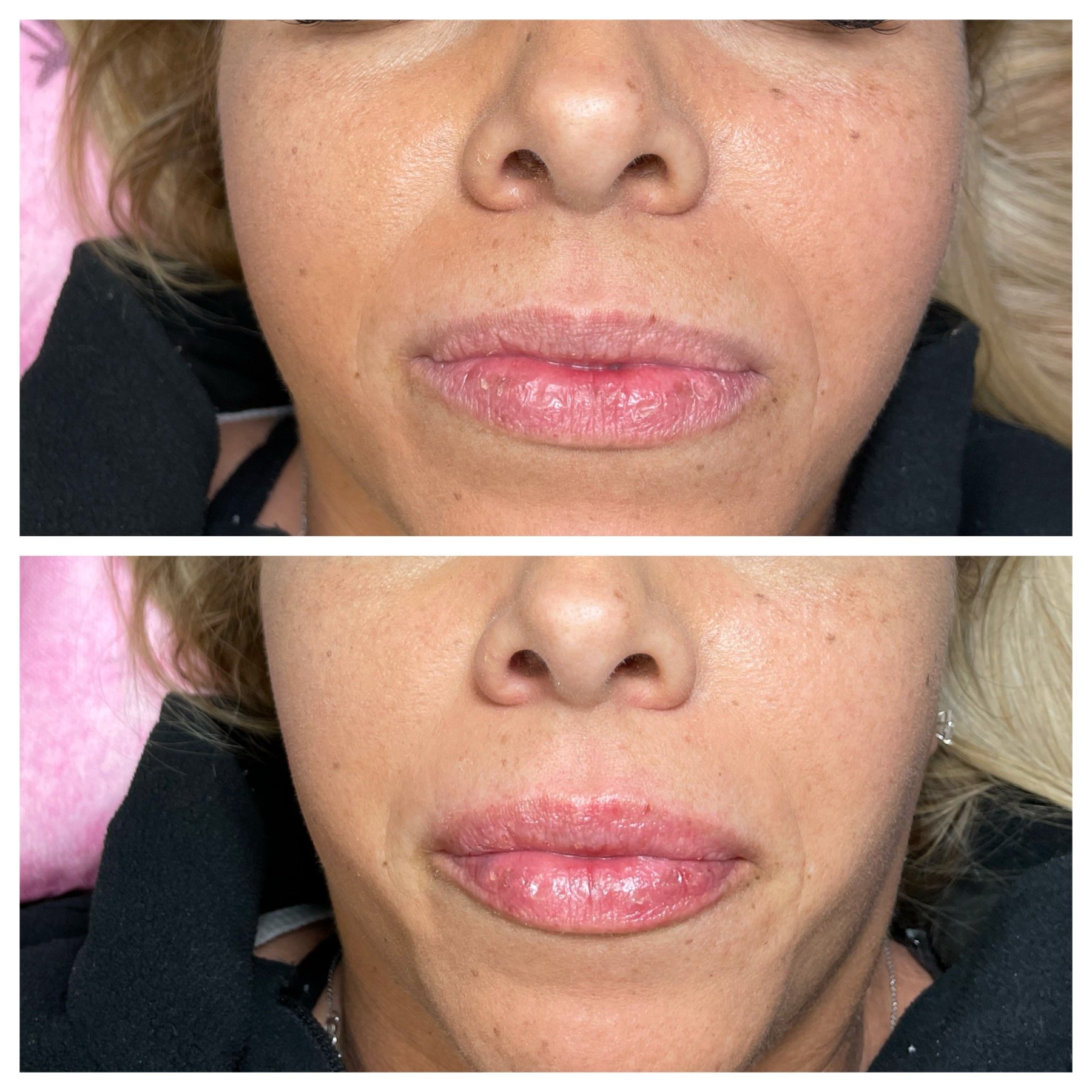 NeedleLess Lip Fillers,Microcurrent, Botox Facial, Eyelash Extensions