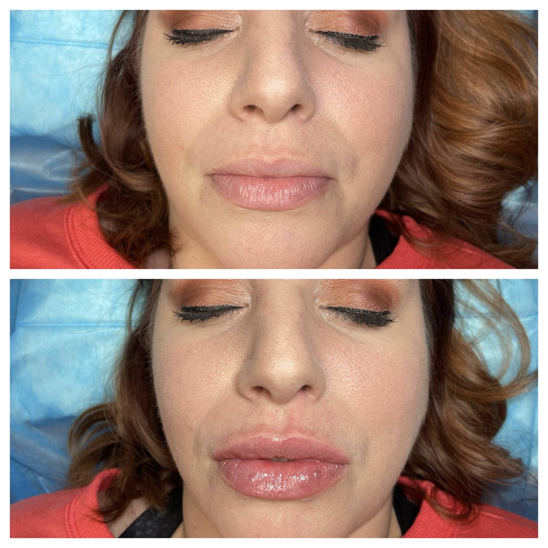 NeedleLess Lip Fillers, Hyaluron Pen Eyelash Extensions , Ombre Brows