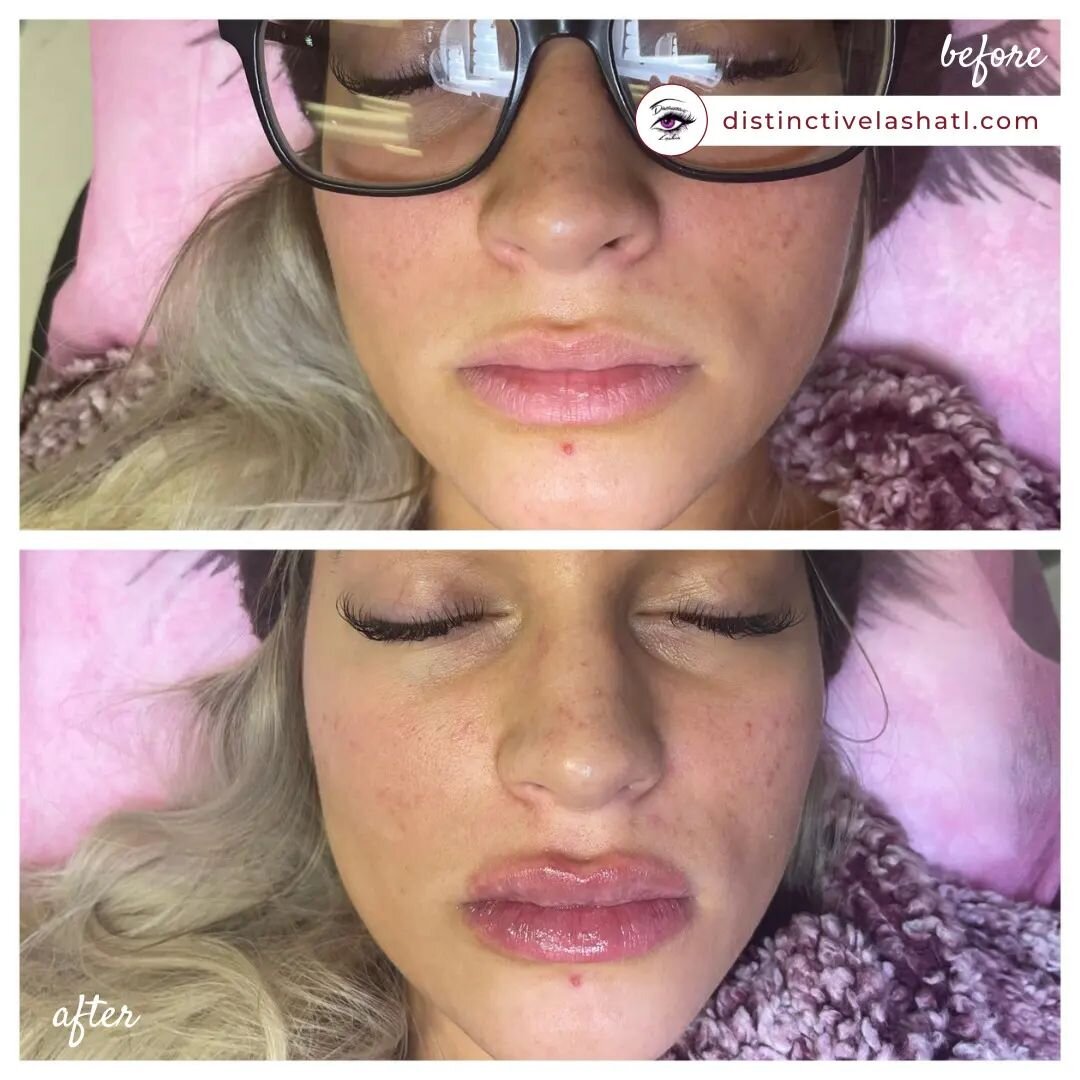 Lip Filler before and after by Distinctive Lashes Woodstock 💉

Lip filler does not always look unnatural or 'fake'. NEEDLE FREE HYALURON PEN can be injected with techniques that can make your lips look natural, hydrated and plump. 

Book your next t