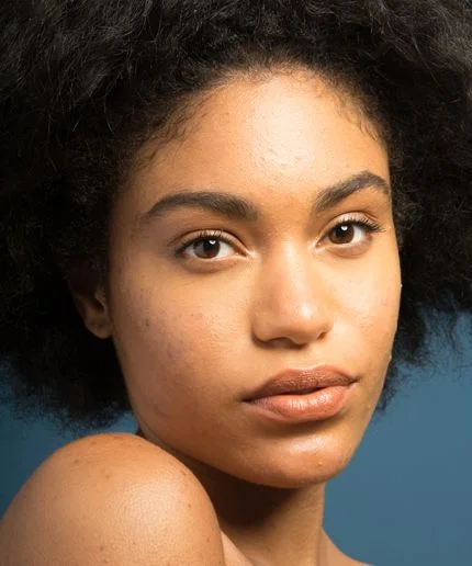 3 Alternative Acne Treatments Worth Trying